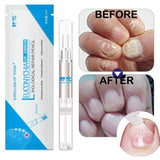  Onychomycosis Paronychia Anti Fungal Nail Infection Liquid Fungal Nail Treatment Pen Chinese Herbal Care Medicinal 